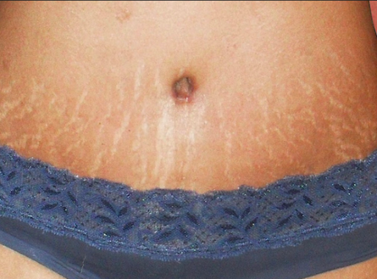 Free Stretch Mark Removal