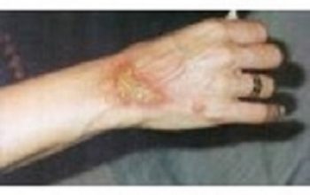 Skin Diseases and Treatment