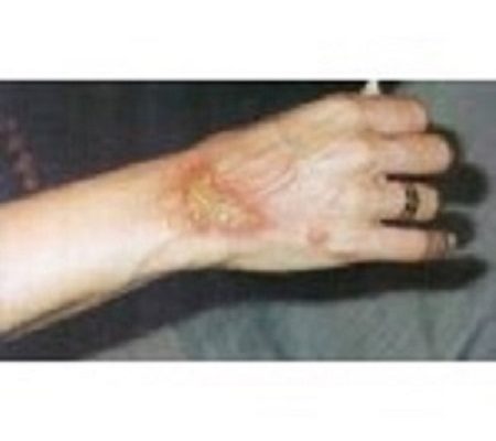 Skin Diseases and Treatment