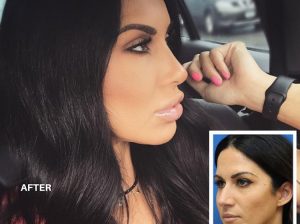 Non Surgical Nose Job NY