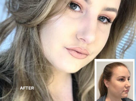 Forehead Lift Surgery NYC