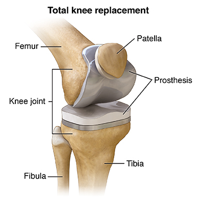 Total Knee Replacement Surgeon in Delhi
