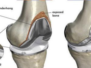 Best Knee replacement Surgeon in Delhi