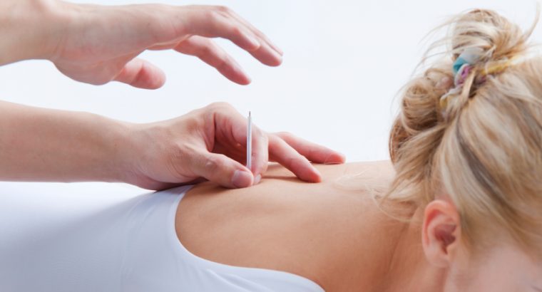 Acupuncture Therapy For Migraines
