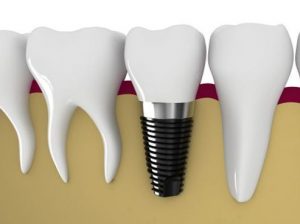 Dental Implants – A Permanent Solution For Missing Teeth | Lifestyle Dental