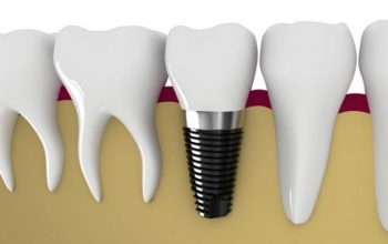 Dental Implants – A Permanent Solution For Missing Teeth | Lifestyle Dental