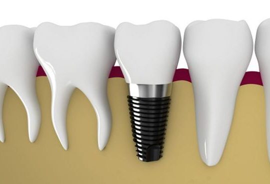 Dental Implants – A Permanent Solution For Missing Teeth | Lifestyle Dental