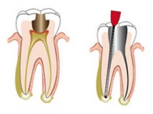 Teeth Root Canal Treatment In Sydney | Expert Endodontics