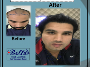 Hair transplant in Indore, Dewas, Delhi (Minimum Cost)
