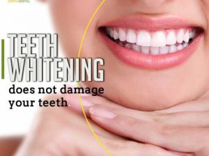 Teeth Whitening in Gurgaon