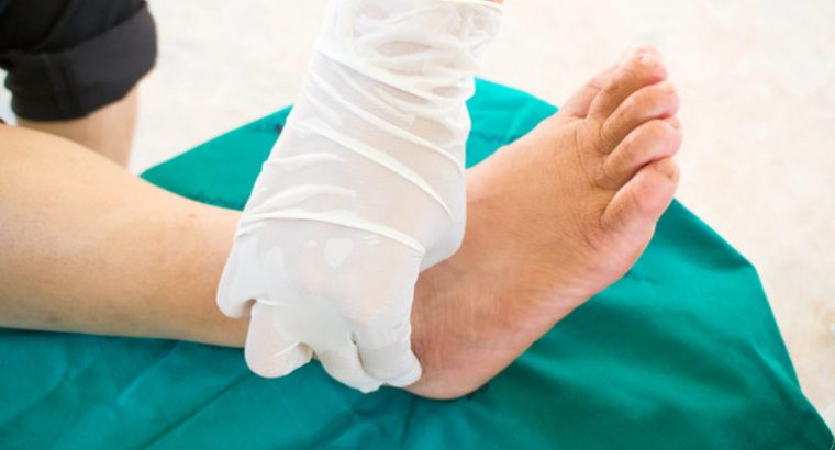 Charcot Foot | Dr Oleg Karpenko,DPM