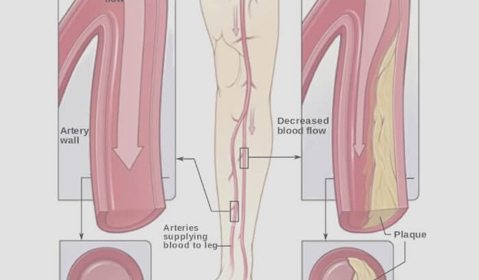 Leg Cramps/Peripheral Artery +1 678-580-1149