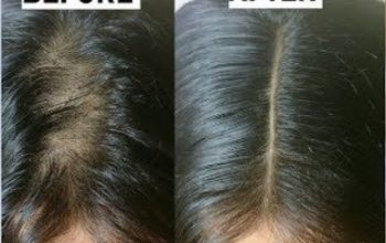 Dr StemWong Hair Growth Oil Combo Ayurvedic Results in 14 Days