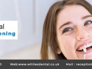 Teeth Whitening At Whites Dental London