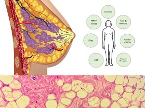 Dr. Steven Quay What causes dense breast tissue?