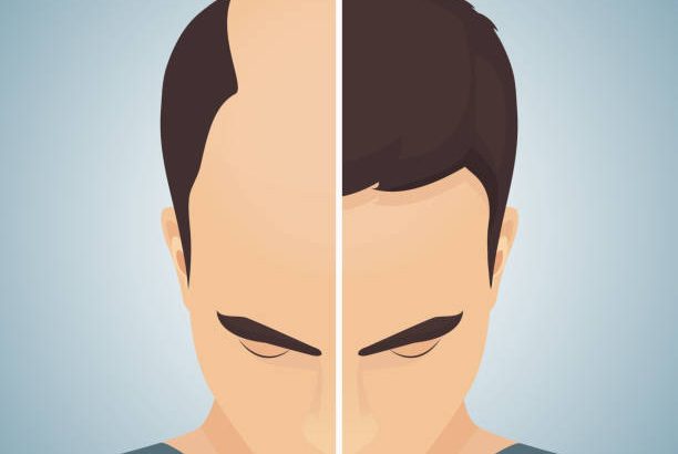 Affordable Hair Transplant Clinic in London