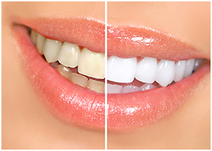 Cosmetic Teeth Whitening Nokomis | Dr. Keith Blessitt – We Make Smiles