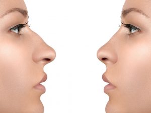 Best Rhinoplasty (Nose Reshaping) Clinic in Hyderabad
