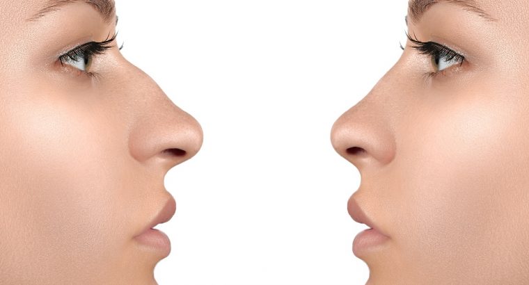 Best Rhinoplasty (Nose Reshaping) Clinic in Hyderabad