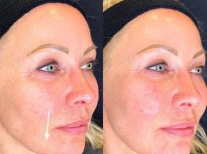 Dermal Fillers in London | Botox and fillers | Restore & Plump Skin