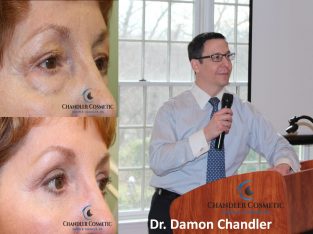 Eyelid Surgery Main Line, PA – Chandler Cosmetic Surgery