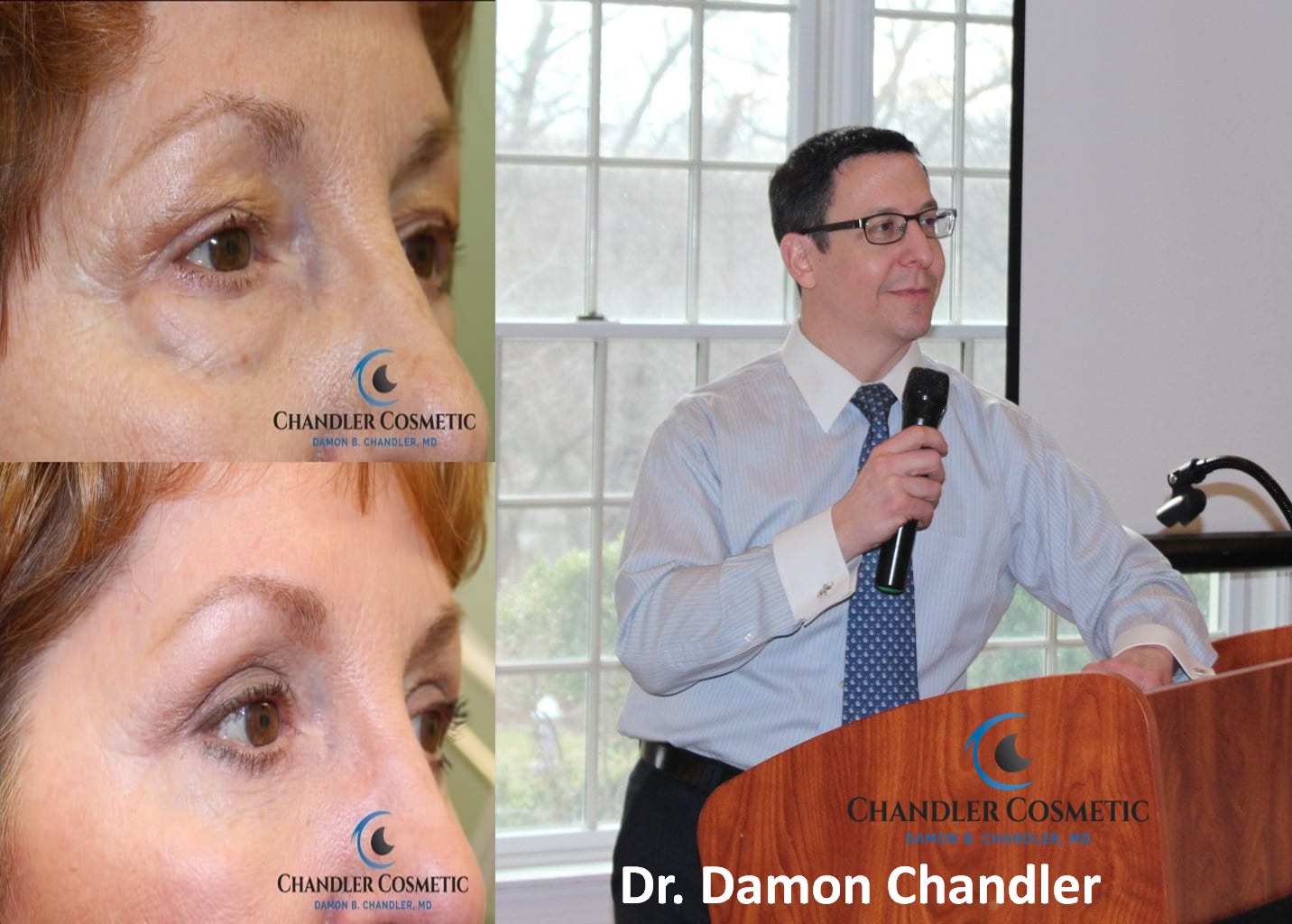 Eyelid Surgery Main Line, PA – Chandler Cosmetic Surgery