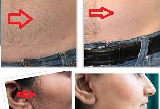 Dr Me Ping Gel Permanent Facial Hair Removal Without Pen 15 Places That You Can Find