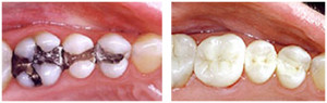 Dental Implant Dentist in Nokomis: We Make Smiles