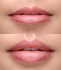 Best Natural Lip Fillers, Lip injections & Lip augmentation in London