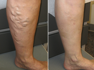 Feel Better With Varicose Veins Treatment in Jaipur