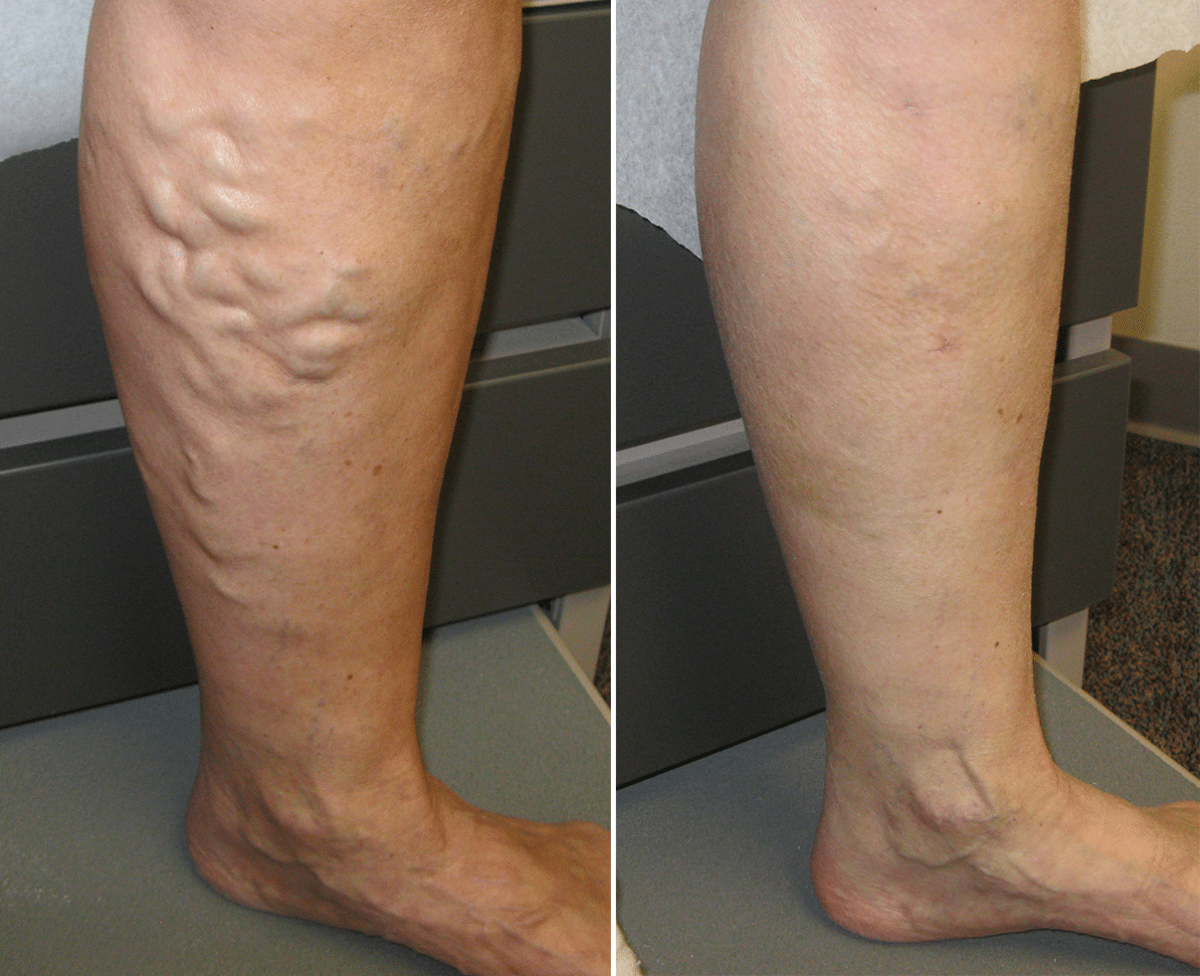 Feel Better With Varicose Veins Treatment in Jaipur