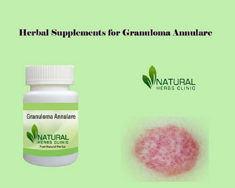 Herbal Supplements for Granuloma Annulare