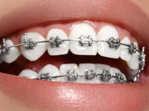 Looking For Affordable Braces in Mira Road – Smiling Teeth