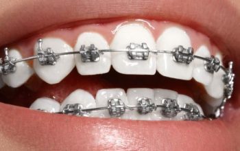 Looking For Affordable Braces in Mira Road – Smiling Teeth