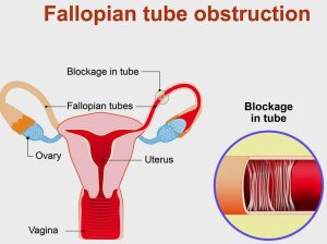 Fallopian Tube Blockage Treatment in London