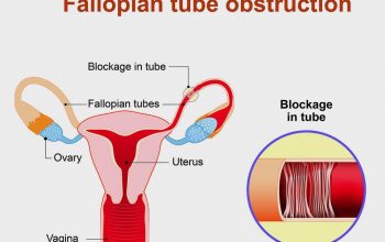 Fallopian Tube Blockage Treatment in London