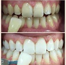 Ipswich teeth whitening 