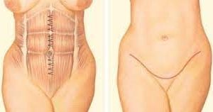 Tummy Tuck Surgery Cost in Jaipur