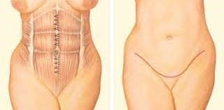 Tummy Tuck Surgery Cost in Jaipur