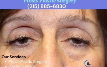 5 Important Things to Consider Before Ptosis Plastic Surgery