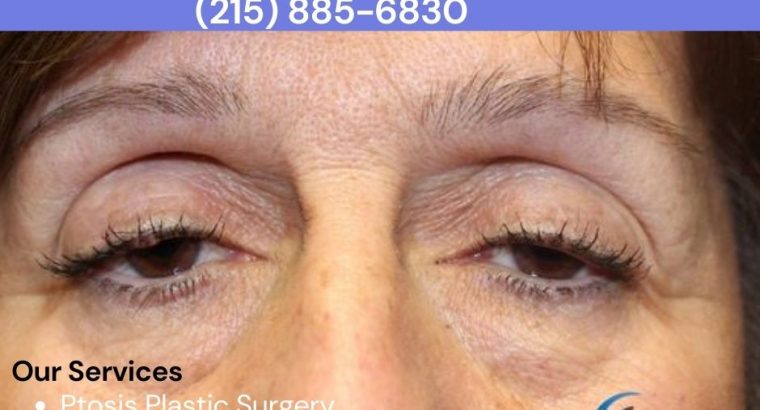 5 Important Things to Consider Before Ptosis Plastic Surgery