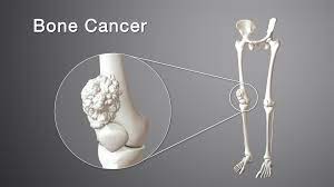 Bone Cancer Doctor in Jaipur