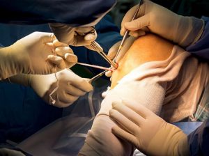 Arthroscopy Surgery In Jaipur