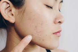 Acne Scars Treatment in Jaipur
