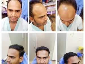 Hair Fall Treatment in Jaipur