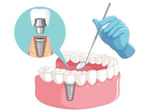 Dental Implants South East London
