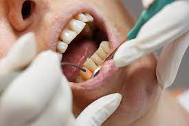 Dental Implants Dentist in Nokomis, FL | Dr. Keith Blessitt