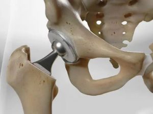 Hip Replacement Surgery Cost in Delhi