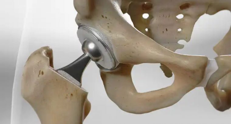 Hip Replacement Surgery Cost in Delhi