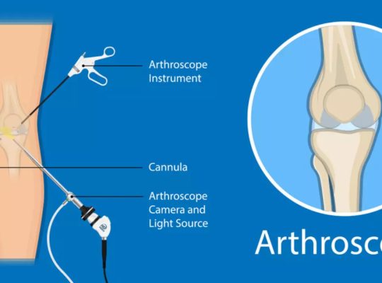 Arthroscopy in Hindi – आर्थोस्कोपी सर्जरी क्या होती हैं?